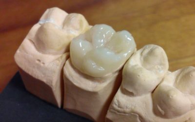 ENDOKORONA- alternatywna, minimalnie inwazyjna metoda odbudowy zębów bocznych po leczeniu endodontycznym